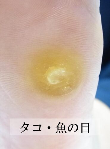 湘南台　巻き爪　魚の目