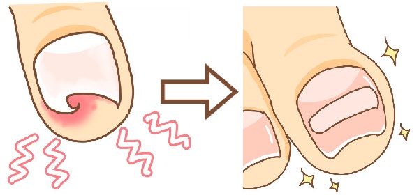 湘南台　巻き爪　バナー
