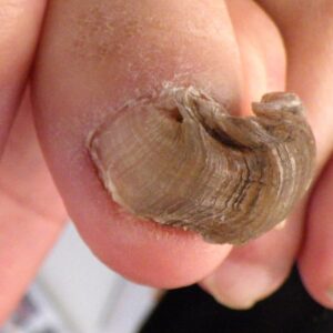 湘南台　巻き爪　変形爪