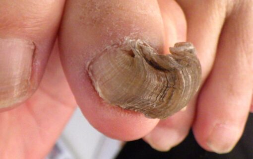 湘南台　巻き爪　変形爪