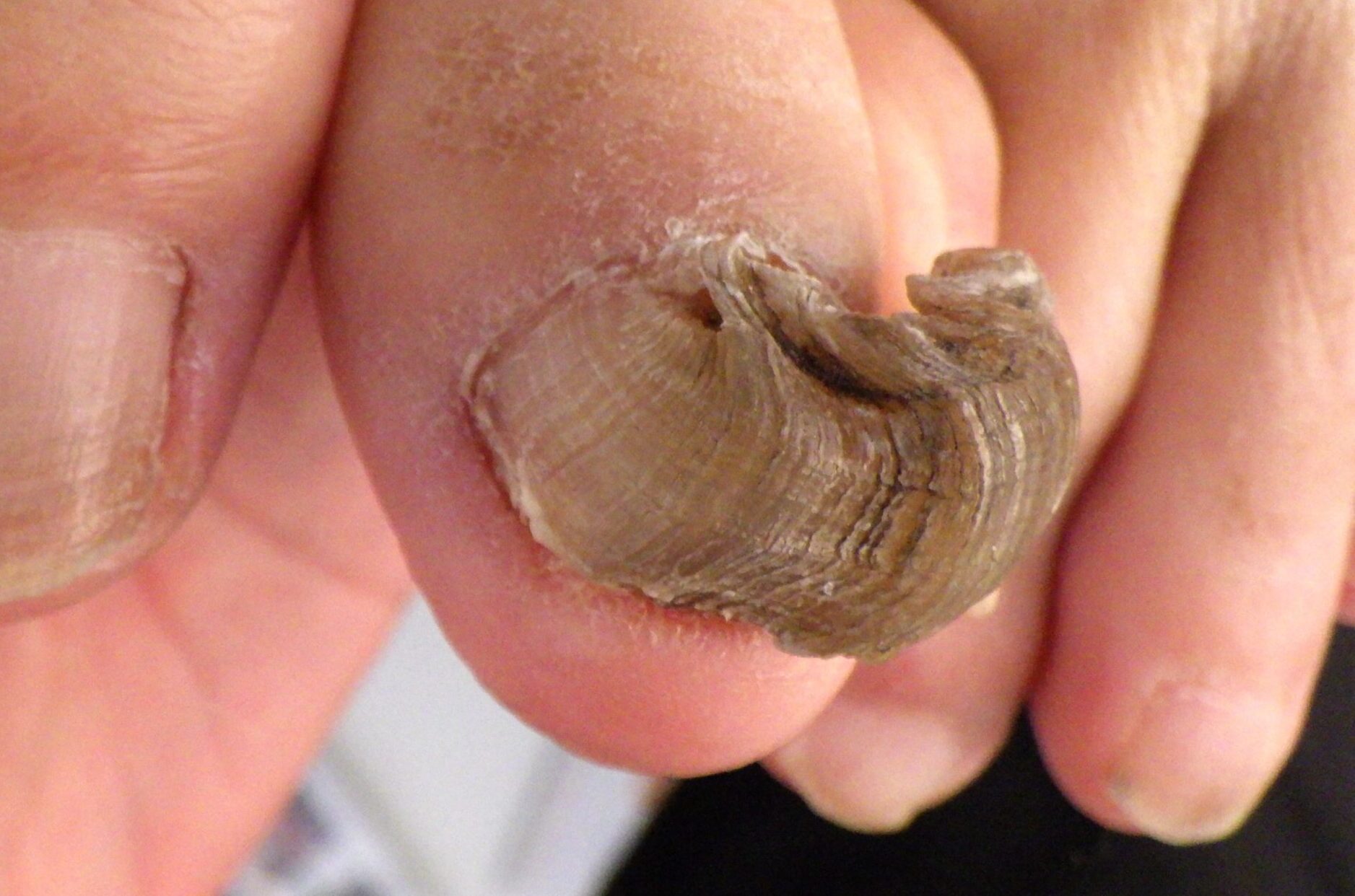 湘南台　巻き爪　変形爪