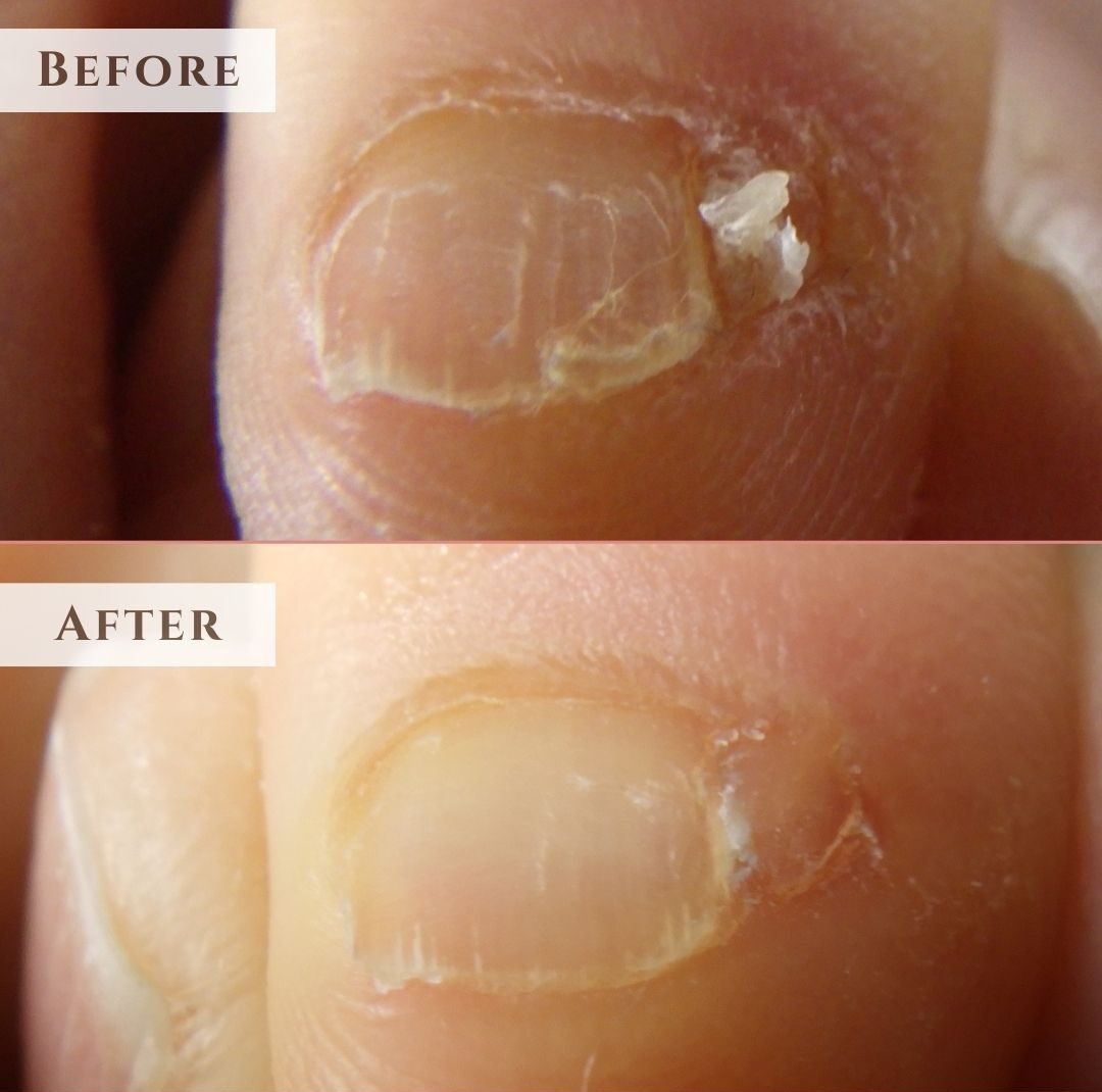 湘南台　巻き爪　副爪