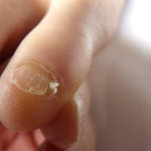 湘南台　巻き爪　副爪