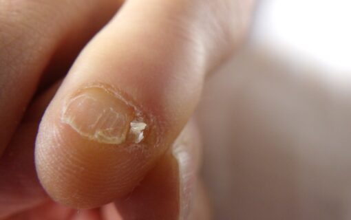 湘南台　巻き爪　副爪