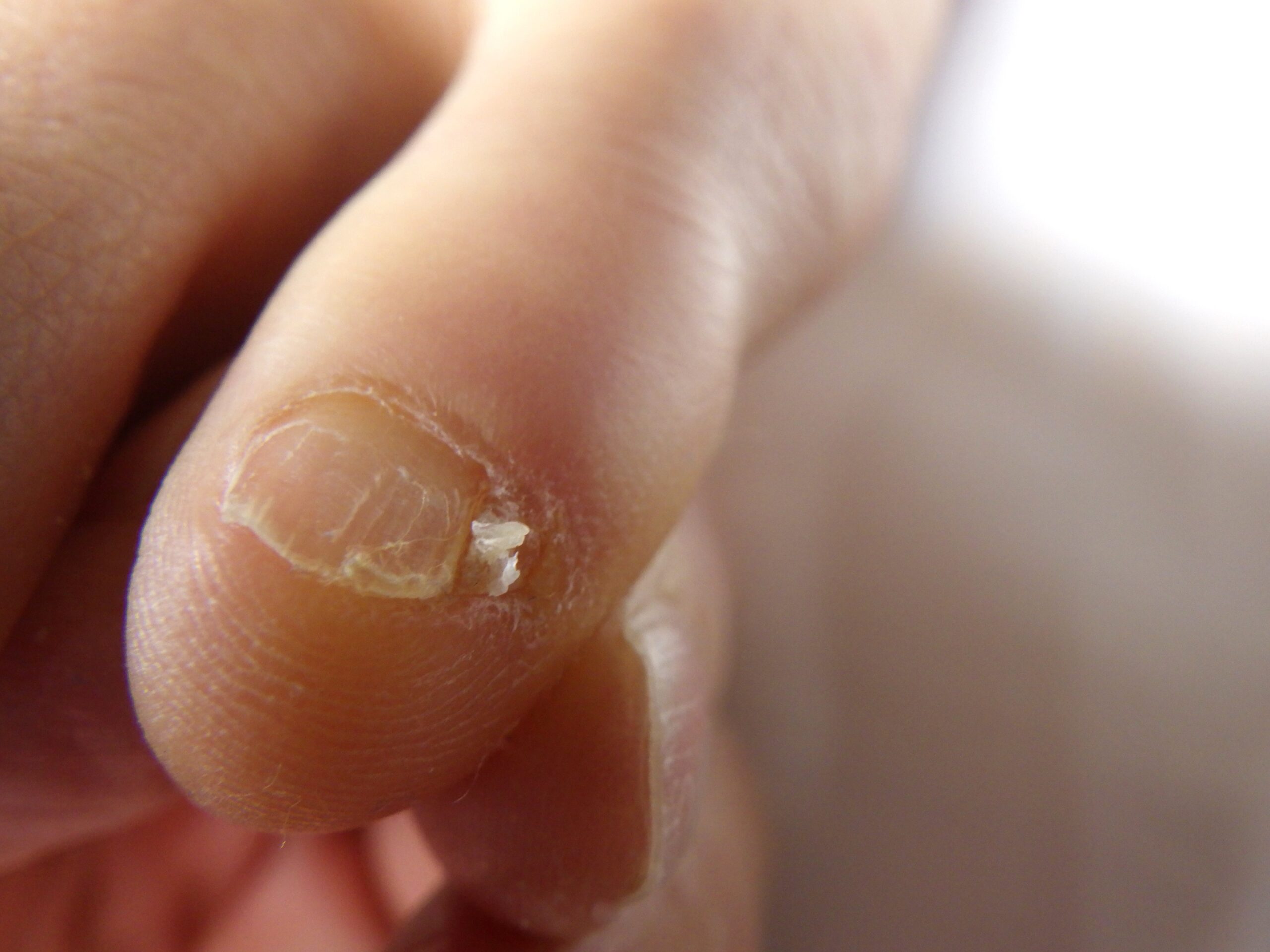 湘南台　巻き爪　副爪