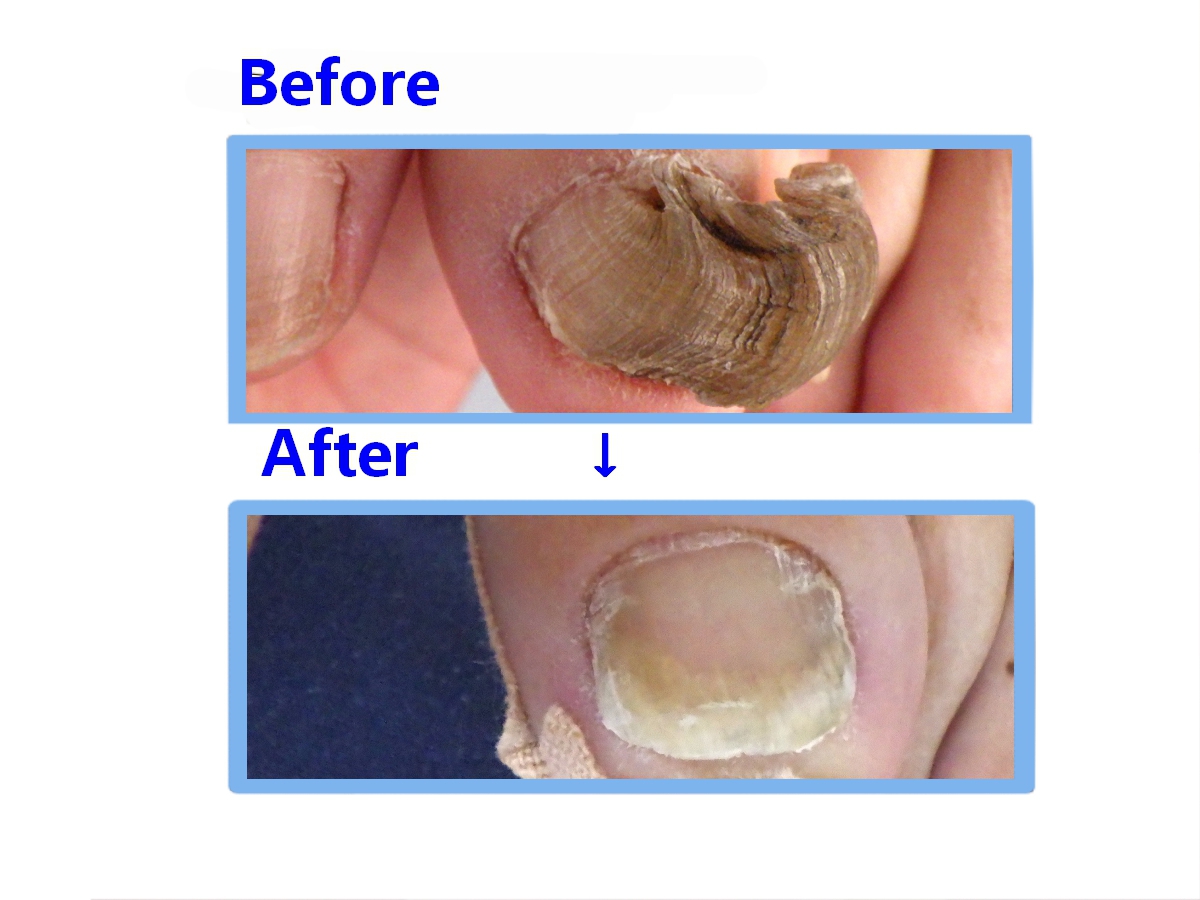 湘南台　巻き爪　変形爪