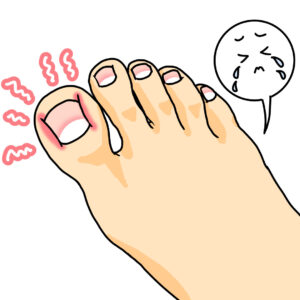 湘南台　巻き爪　足