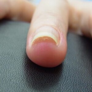 湘南台　巻き爪　手