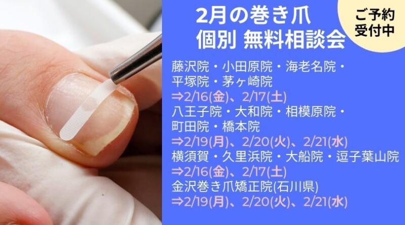 逗子市　巻き爪　無料相談会