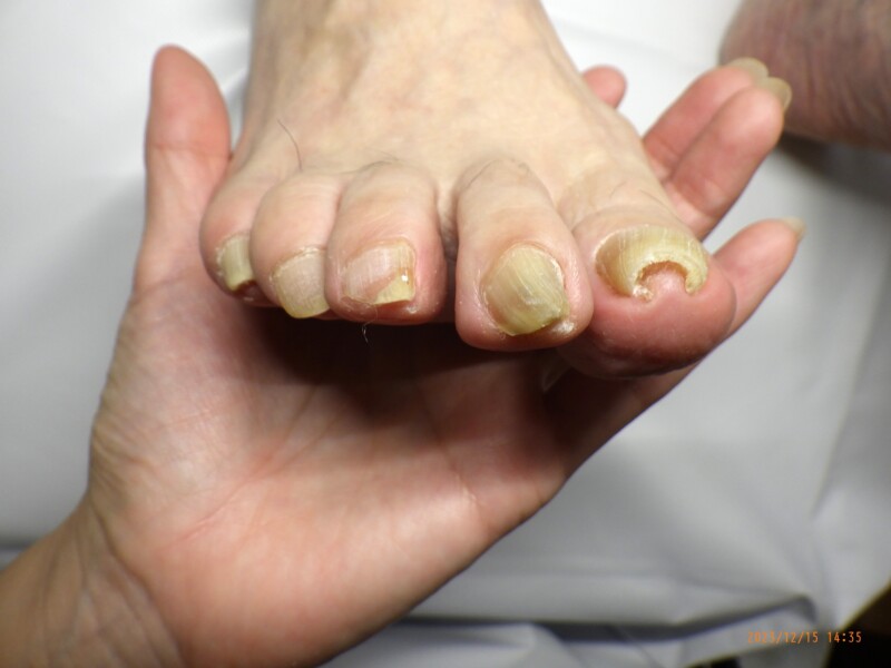 逗子市　巻き爪　ビフォー