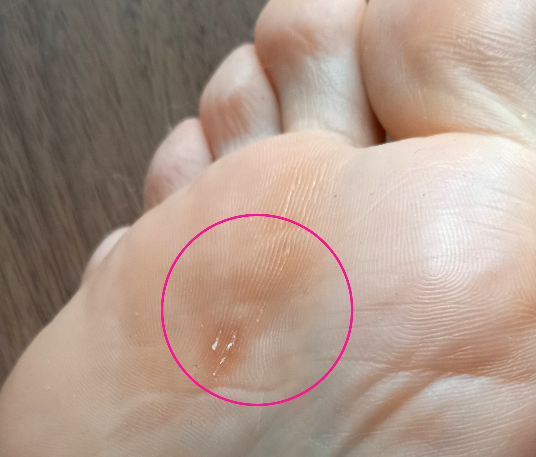 逗子市　巻き爪　足裏