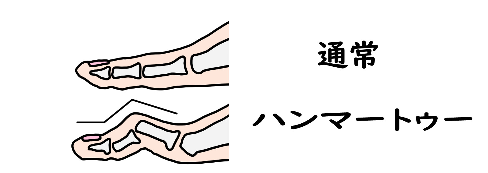 逗子市　巻き爪　足の指