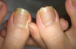 逗子市　巻き爪　ビフォー