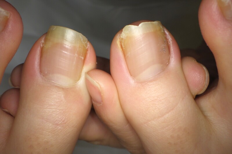 逗子市　巻き爪　ビフォー