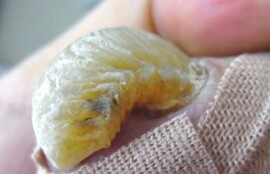 逗子市 巻き爪 変形爪