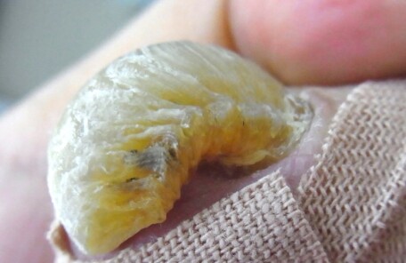 逗子市　巻き爪　変形爪