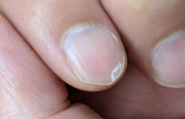 逗子市　巻き爪　二枚爪