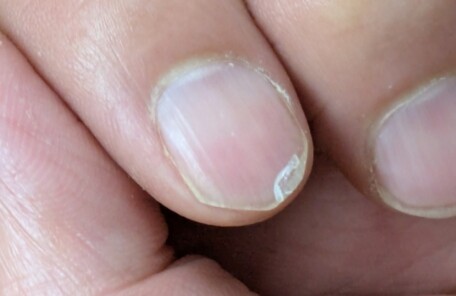 逗子市　巻き爪　二枚爪