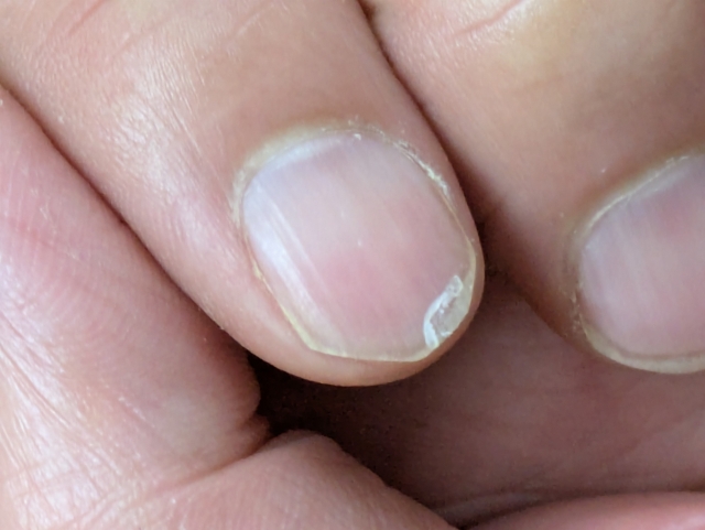 逗子市　巻き爪　二枚爪