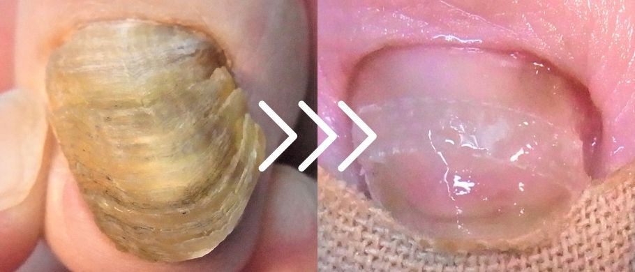 逗子市　巻き爪　変形爪