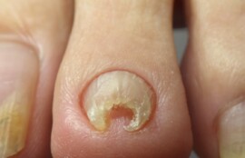 逗子市　巻き爪　ビフォー