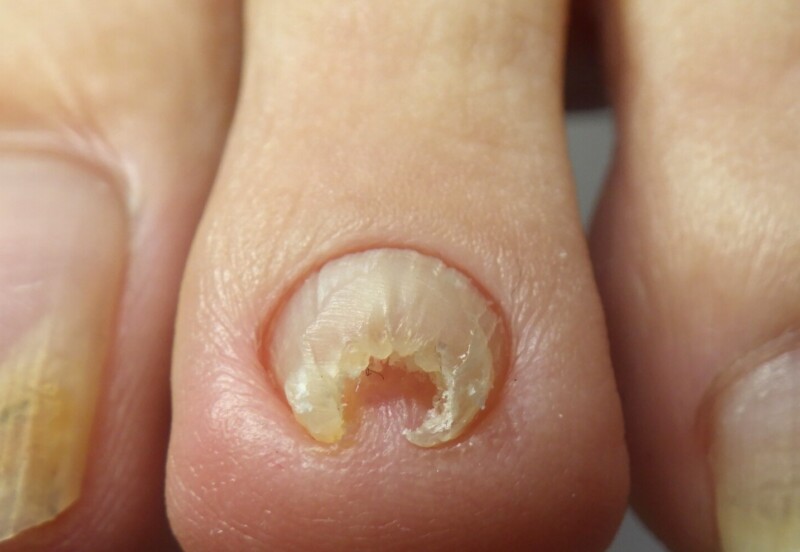 逗子市　巻き爪　ビフォー