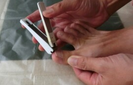 逗子市　巻き爪　爪切り