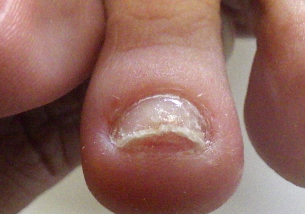 逗子市　巻き爪　アフター