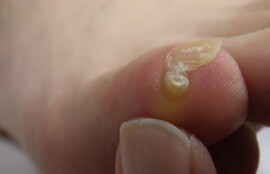 逗子市　巻き爪　副爪