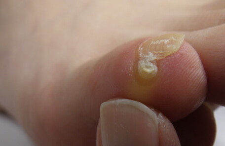 逗子市　巻き爪　副爪