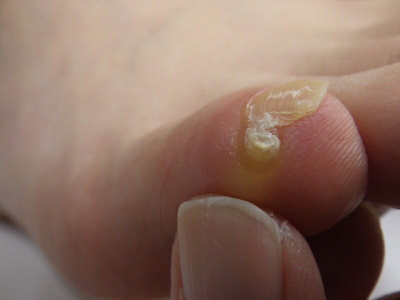 逗子市　巻き爪　副爪