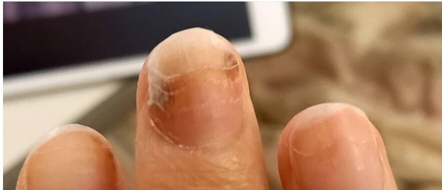 逗子市　巻き爪　指