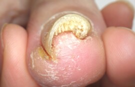 逗子市　巻き爪　ビフォー