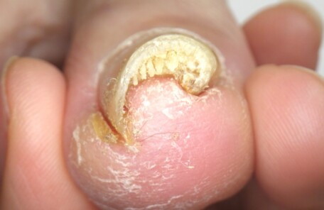 逗子市　巻き爪　ビフォー