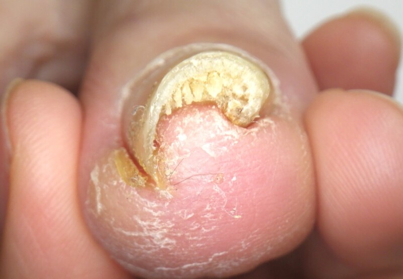 逗子市　巻き爪　ビフォー