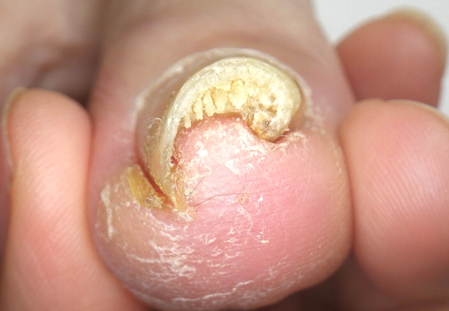 逗子市　巻き爪　ビフォー