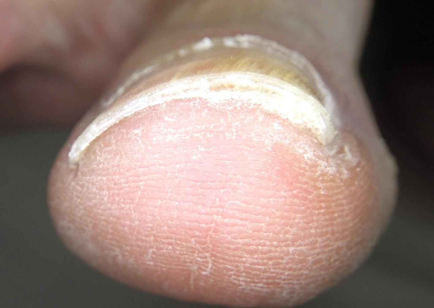 逗子市　巻き爪　アフター