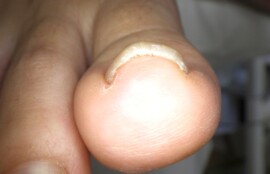 逗子市　巻き爪　ビフォー