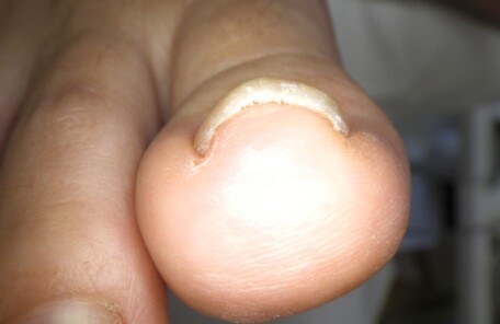 逗子市　巻き爪　ビフォー