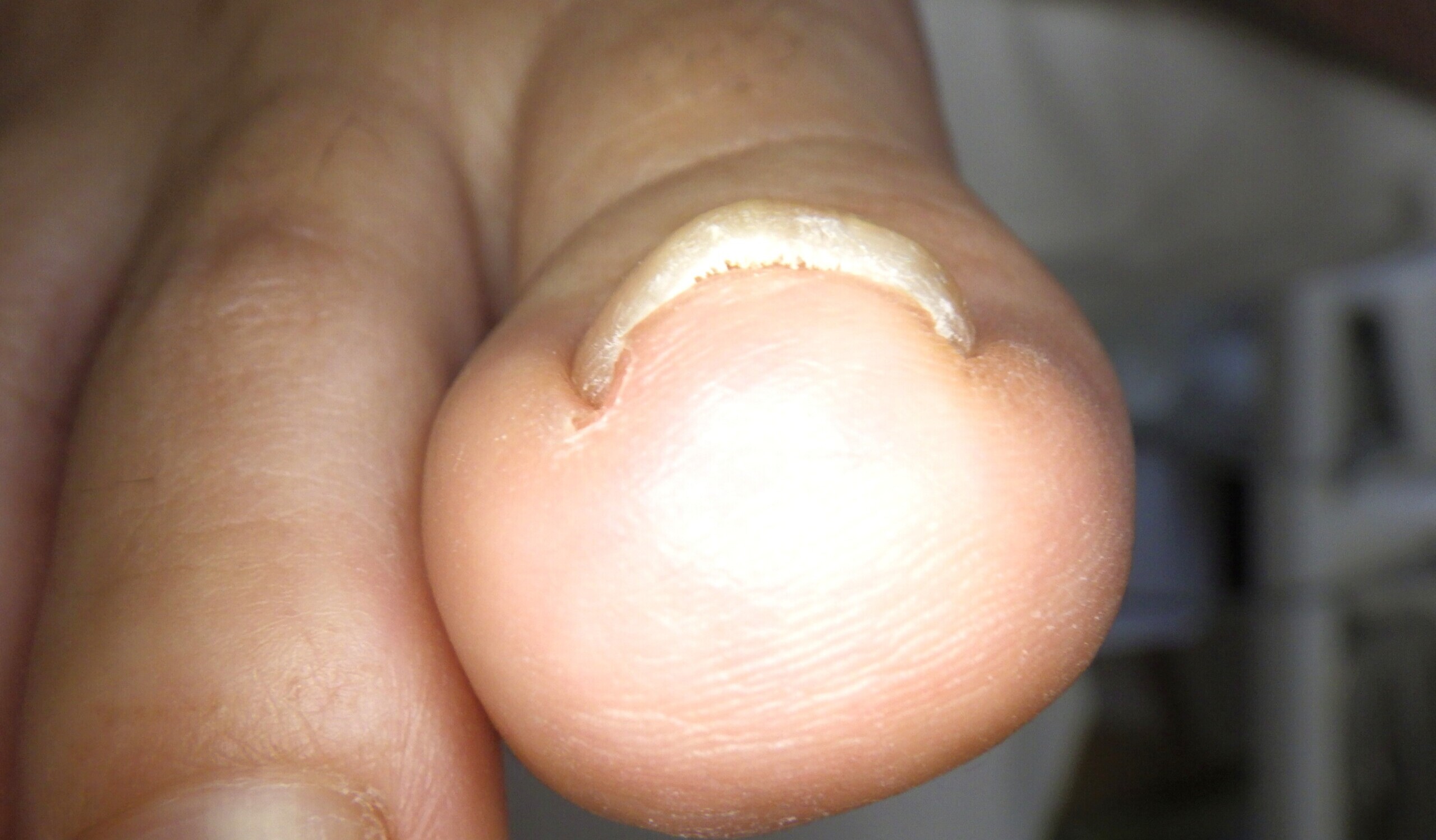 逗子市　巻き爪　ビフォー