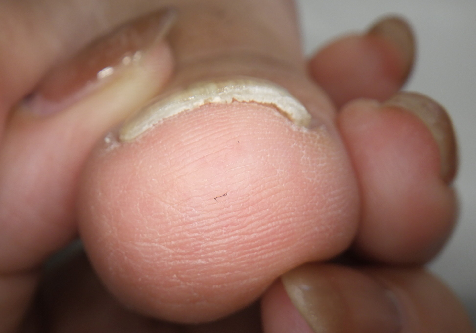 逗子市　巻き爪　アフター